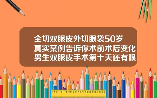 全切双眼皮外切眼袋50岁真实案例告诉你术前术后变化男生双眼皮手术第十天还有眼袋