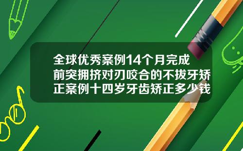 全球优秀案例14个月完成前突拥挤对刃咬合的不拔牙矫正案例十四岁牙齿矫正多少钱