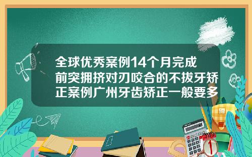 全球优秀案例14个月完成前突拥挤对刃咬合的不拔牙矫正案例广州牙齿矫正一般要多少钱一次