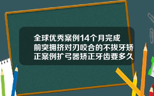 全球优秀案例14个月完成前突拥挤对刃咬合的不拔牙矫正案例扩弓器矫正牙齿要多久