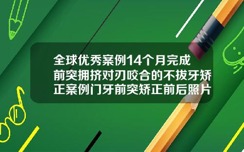 全球优秀案例14个月完成前突拥挤对刃咬合的不拔牙矫正案例门牙前突矫正前后照片