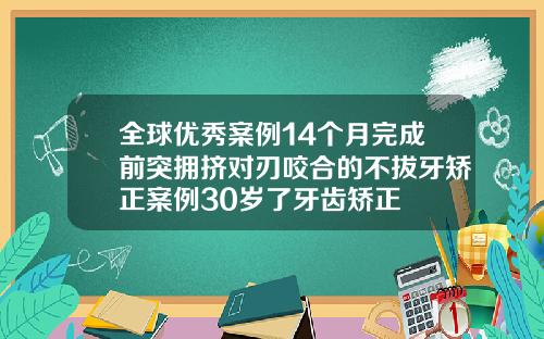 全球优秀案例14个月完成前突拥挤对刃咬合的不拔牙矫正案例30岁了牙齿矫正