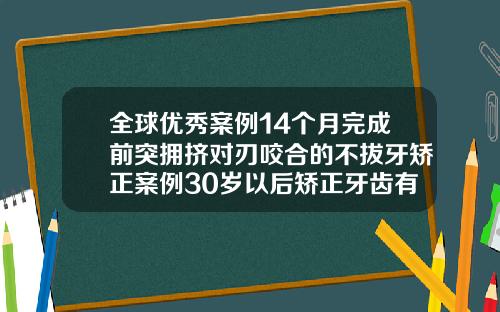 全球优秀案例14个月完成前突拥挤对刃咬合的不拔牙矫正案例30岁以后矫正牙齿有用吗