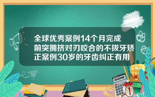 全球优秀案例14个月完成前突拥挤对刃咬合的不拔牙矫正案例30岁的牙齿纠正有用吗