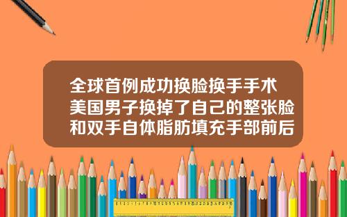 全球首例成功换脸换手手术美国男子换掉了自己的整张脸和双手自体脂肪填充手部前后对比照