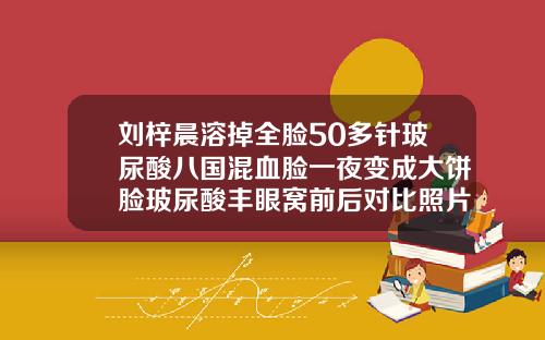 刘梓晨溶掉全脸50多针玻尿酸八国混血脸一夜变成大饼脸玻尿酸丰眼窝前后对比照片