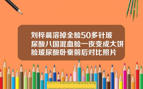 刘梓晨溶掉全脸50多针玻尿酸八国混血脸一夜变成大饼脸玻尿酸卧蚕前后对比照片