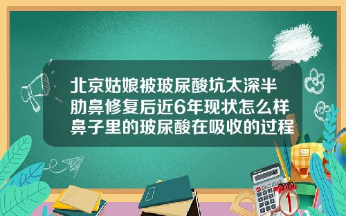 北京姑娘被玻尿酸坑太深半肋鼻修复后近6年现状怎么样鼻子里的玻尿酸在吸收的过程中会变宽吗