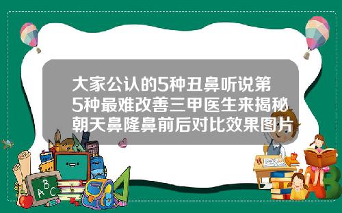 大家公认的5种丑鼻听说第5种最难改善三甲医生来揭秘朝天鼻隆鼻前后对比效果图片