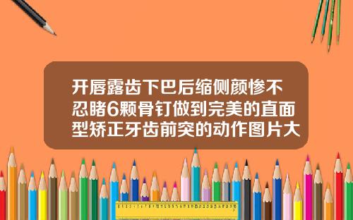 开唇露齿下巴后缩侧颜惨不忍睹6颗骨钉做到完美的直面型矫正牙齿前突的动作图片大全