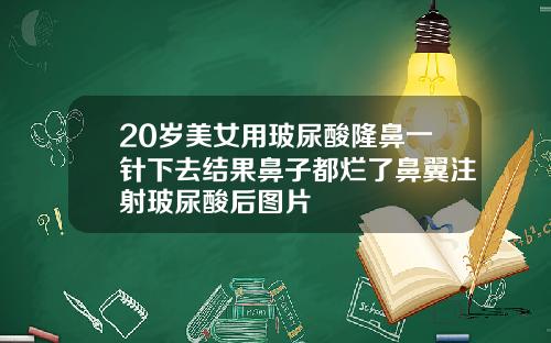 20岁美女用玻尿酸隆鼻一针下去结果鼻子都烂了鼻翼注射玻尿酸后图片