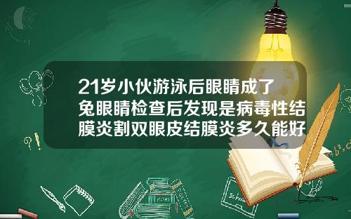 21岁小伙游泳后眼睛成了兔眼睛检查后发现是病毒性结膜炎割双眼皮结膜炎多久能好