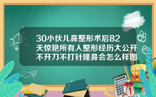 30小伙儿鼻整形术后82天惊艳所有人整形经历大公开不开刀不打针隆鼻会怎么样图片