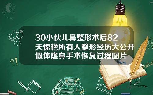 30小伙儿鼻整形术后82天惊艳所有人整形经历大公开假体隆鼻手术恢复过程图片
