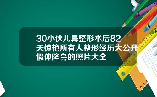 30小伙儿鼻整形术后82天惊艳所有人整形经历大公开假体隆鼻的照片大全