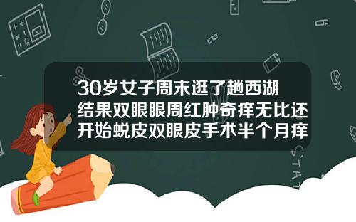 30岁女子周末逛了趟西湖结果双眼眼周红肿奇痒无比还开始蜕皮双眼皮手术半个月痒